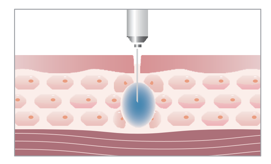 Needle Injection