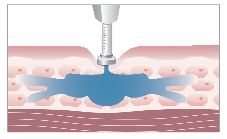 Synaplus Injection
